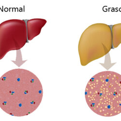 Hígado Graso: ¿Cómo podemos prevenirlo?
